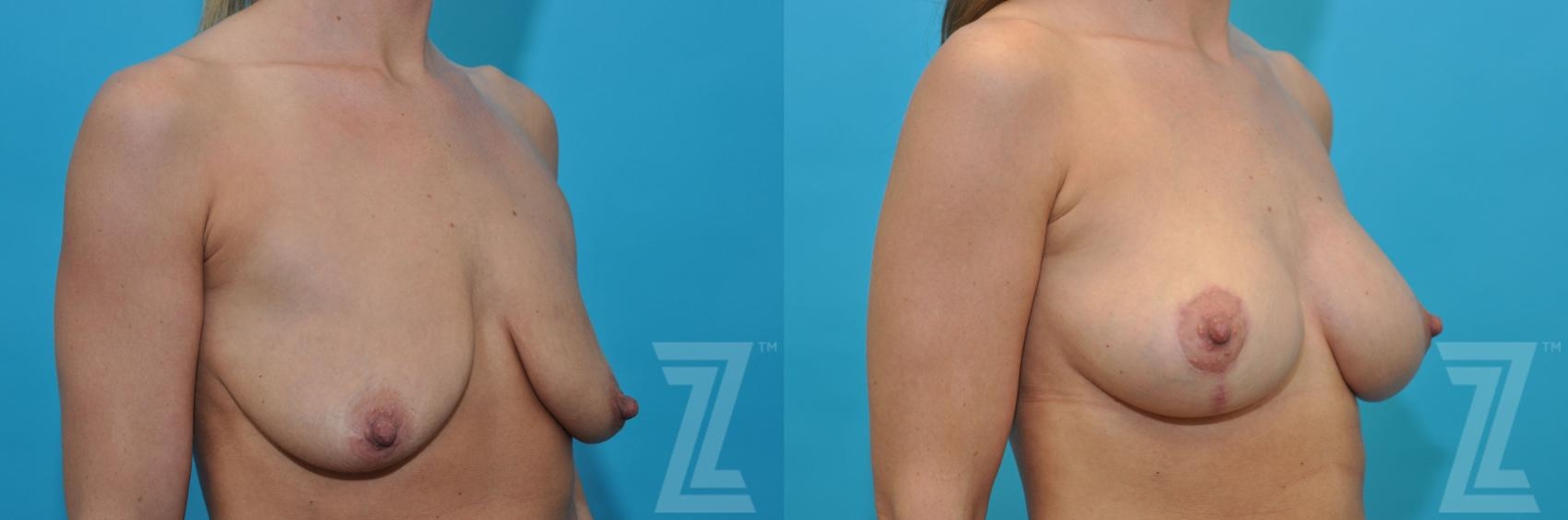 Austin Breast Augmentation With a Breast Lift Before & After Gallery - Patient 132791091 - Image 4 - The Piazza Center