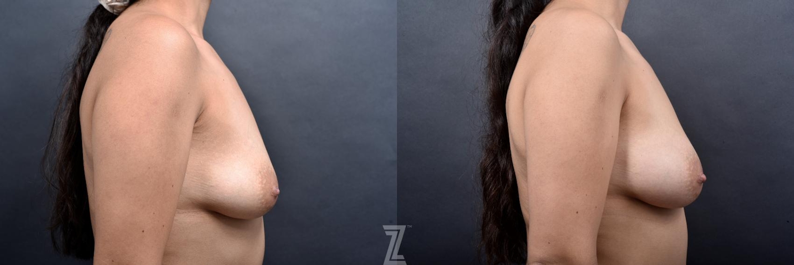 Austin Inverted Nipple Correction Before & After Gallery - Patient 132886790 - Image 5 - The Piazza Center