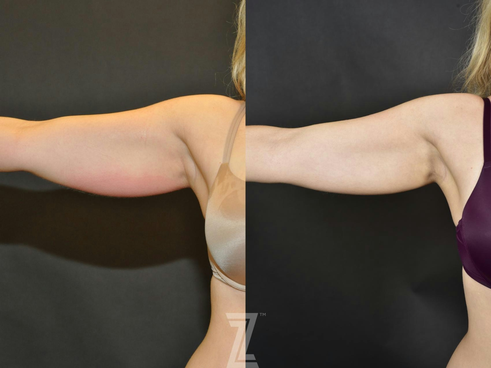 Austin CoolSculpting® Before & After Gallery - Patient 132905382 - Image 2 - The Piazza Center