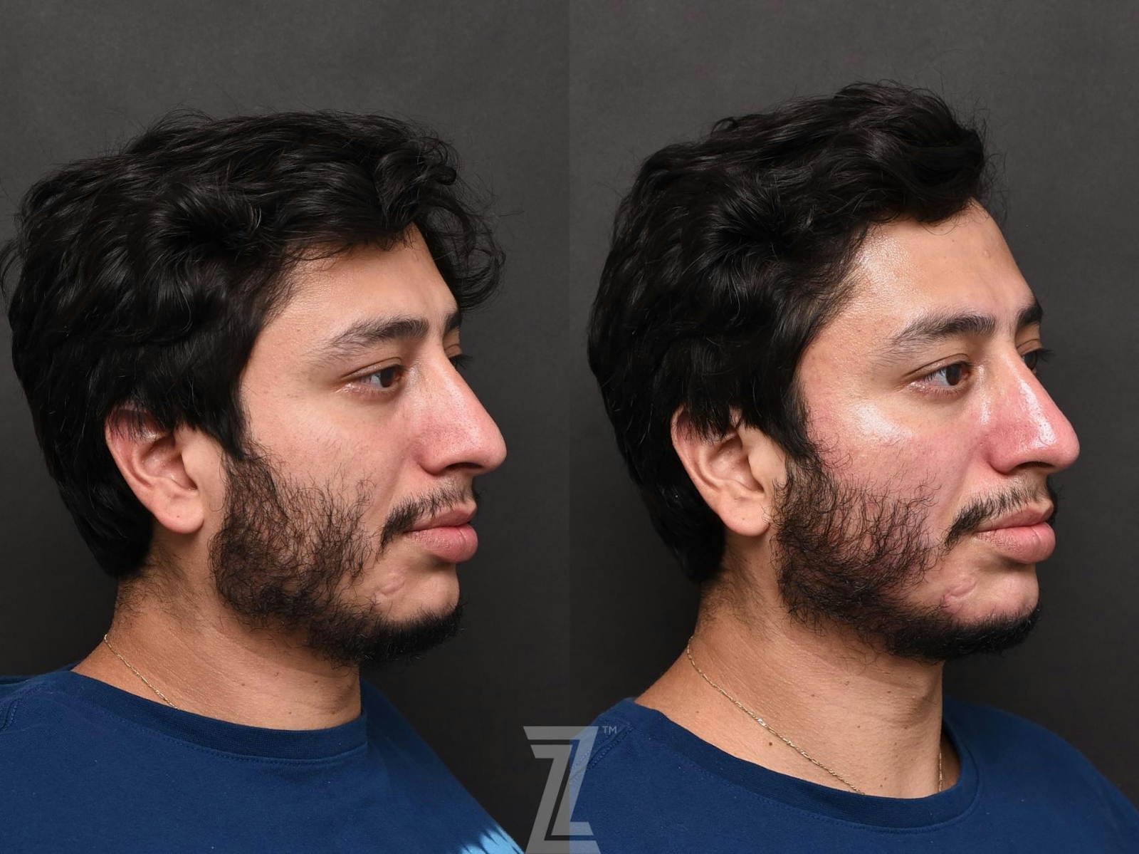 Austin HydraFacial™ Before & After Gallery - Patient 132963244 - Image 2 - The Piazza Center