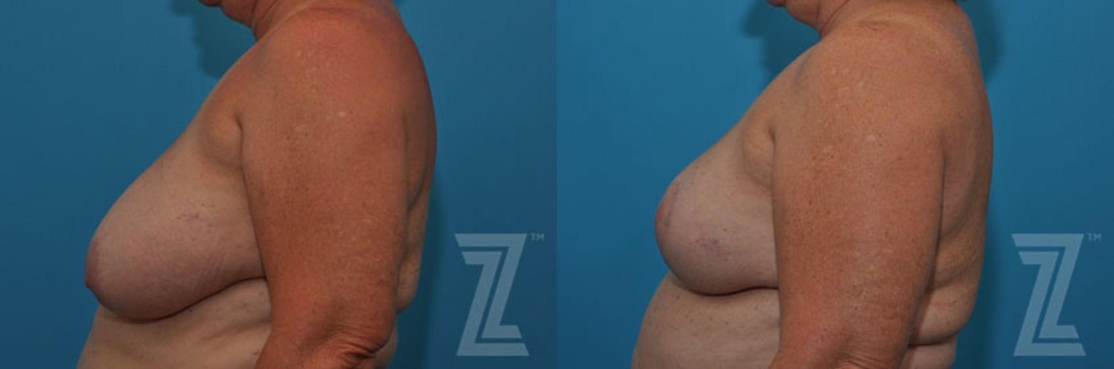 Austin Breast Reduction Before & After Gallery - Patient 132886617 - Image 3 - The Piazza Center