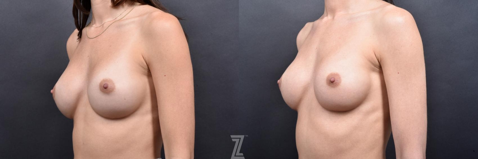 Austin Breast Augmentation Revision Before & After Gallery - Patient 132886545 - Image 2 - The Piazza Center