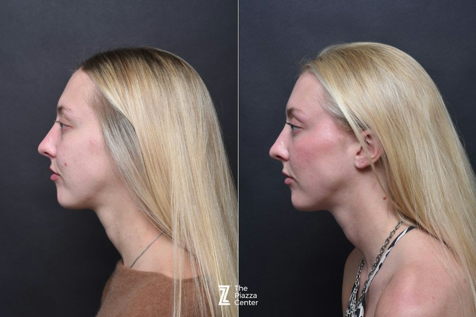 Austin Injectable Fillers Before & After Gallery - Patient 383581 - Image 3 - The Piazza Center