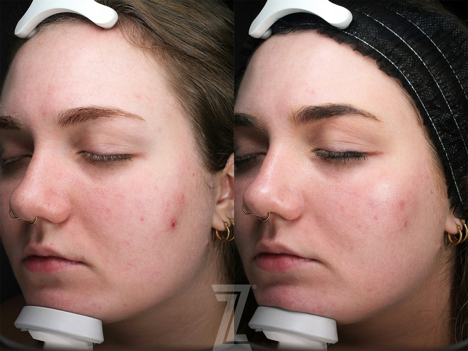 Austin Clear Skin Protocol Before & After Gallery - Patient 348532 - Image 2 - The Piazza Center