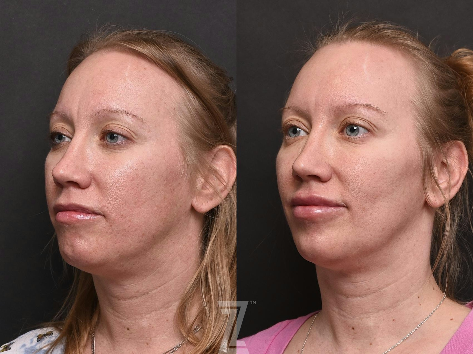 Austin Injectable Fillers Before & After Gallery - Patient 132963112 - Image 1 - The Piazza Center