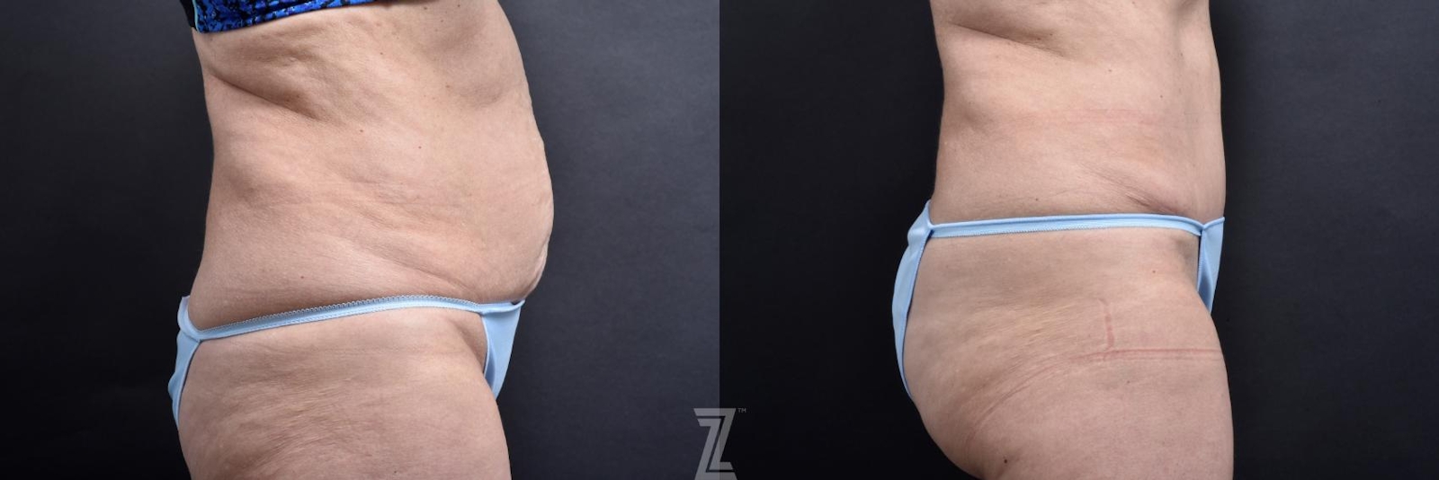 Austin Tummy Tuck Before & After Gallery - Patient 132886818 - Image 4 - The Piazza Center