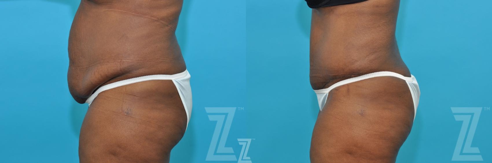 Austin Tummy Tuck Before & After Gallery - Patient 117774 - Image 2 - The Piazza Center