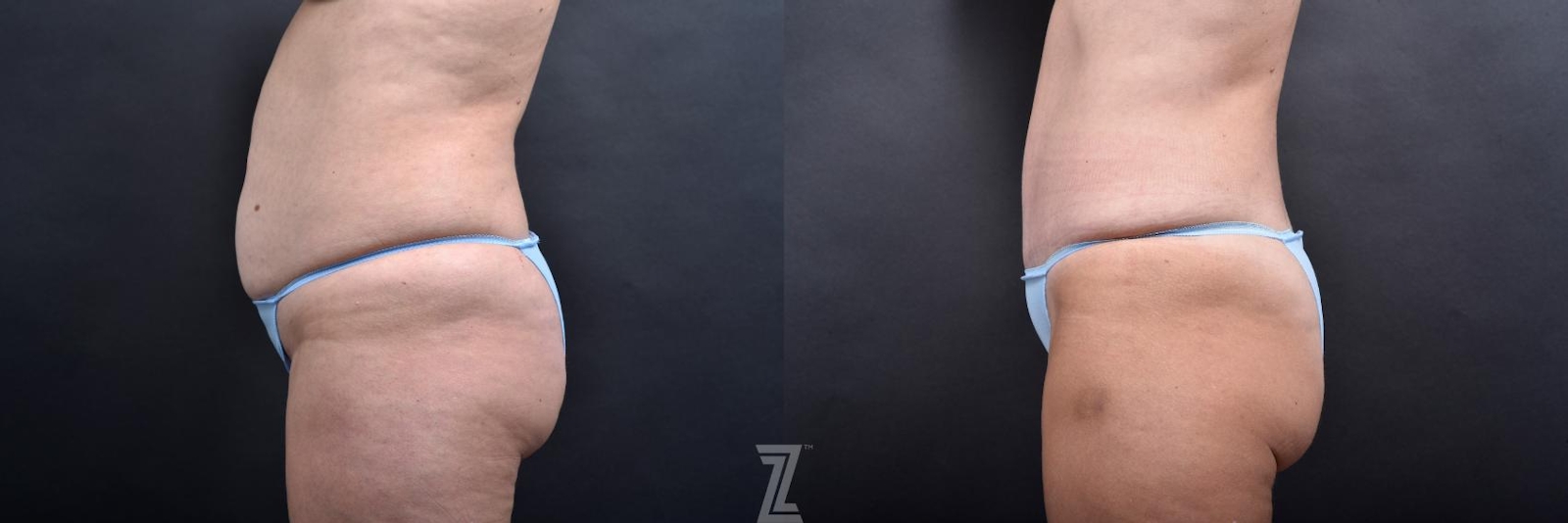 Austin Tummy Tuck Before & After Gallery - Patient 132886865 - Image 2 - The Piazza Center