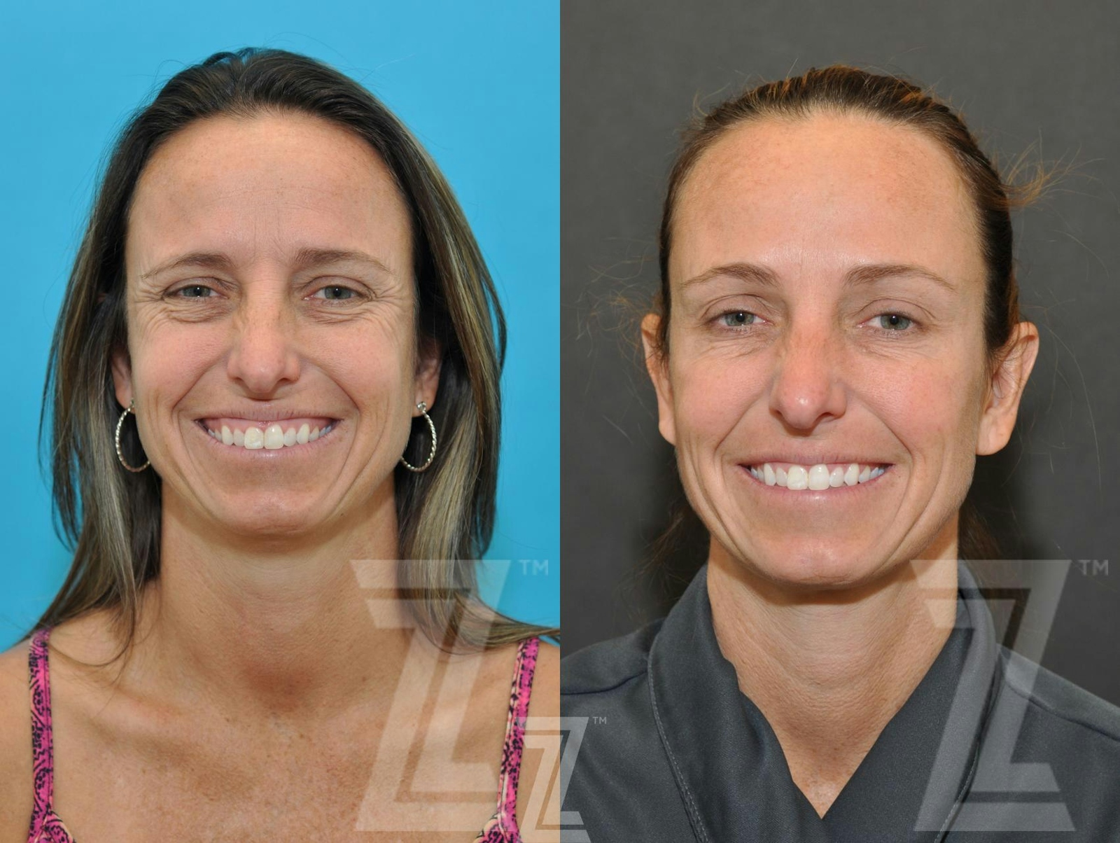 Austin Wrinkle Relaxers Before & After Gallery - Patient 132906321 - Image 4 - The Piazza Center