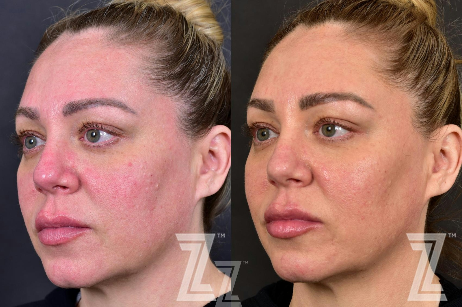 Austin BBL Before & After Gallery - Patient 132963256 - Image 2 - The Piazza Center