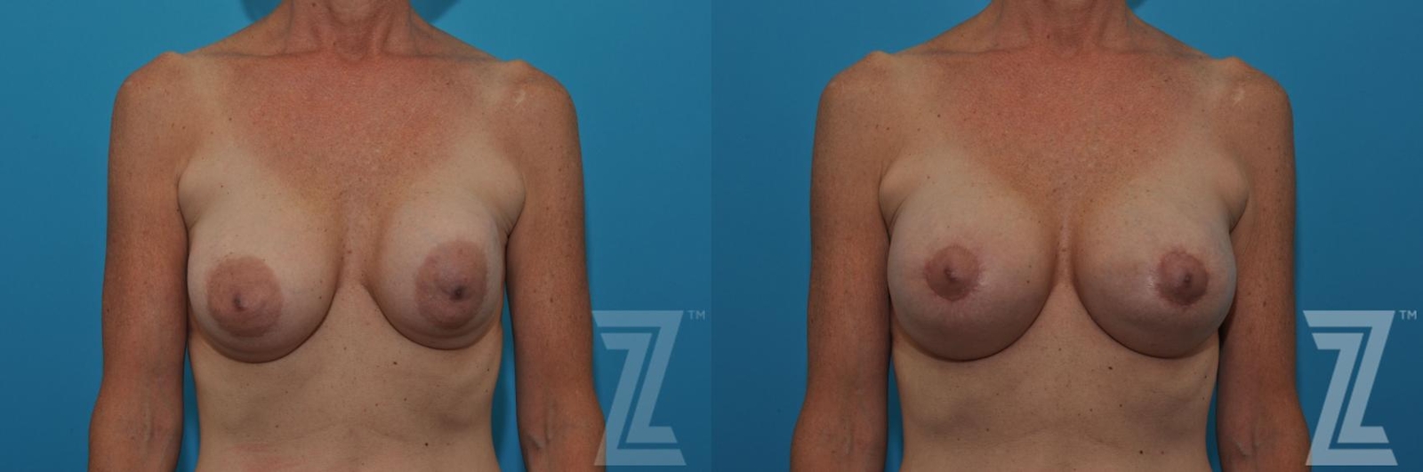 Austin Breast Augmentation Revision Before & After Gallery - Patient 132886537 - Image 1 - The Piazza Center