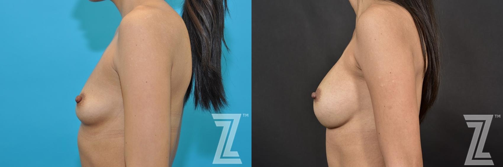 Austin Lateral View Before & After Breast Augmentation of 32-Year-Old Female Patient With Silicone Implants with Cohesive Silicone Gel - The Piazza Center