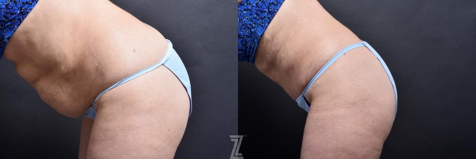 Austin Tummy Tuck Before & After Gallery - Patient 132886818 - Image 2 - The Piazza Center
