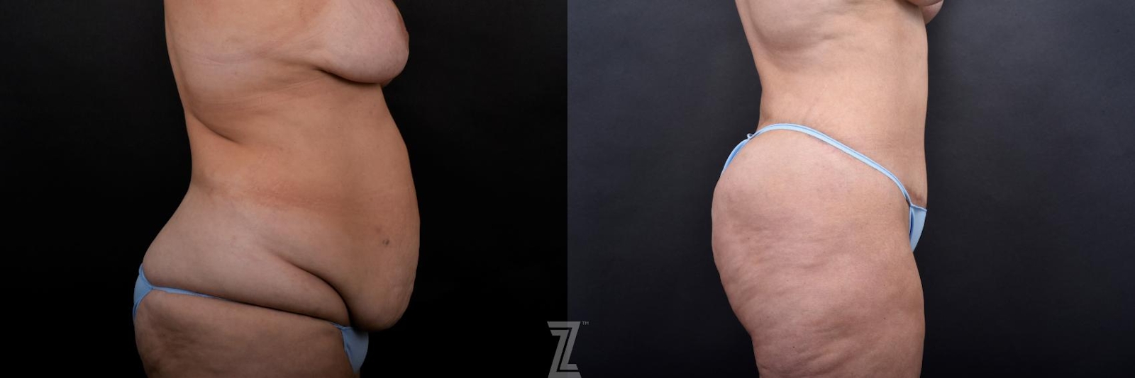 Austin Tummy Tuck Before & After Gallery - Patient 132886815 - Image 4 - The Piazza Center