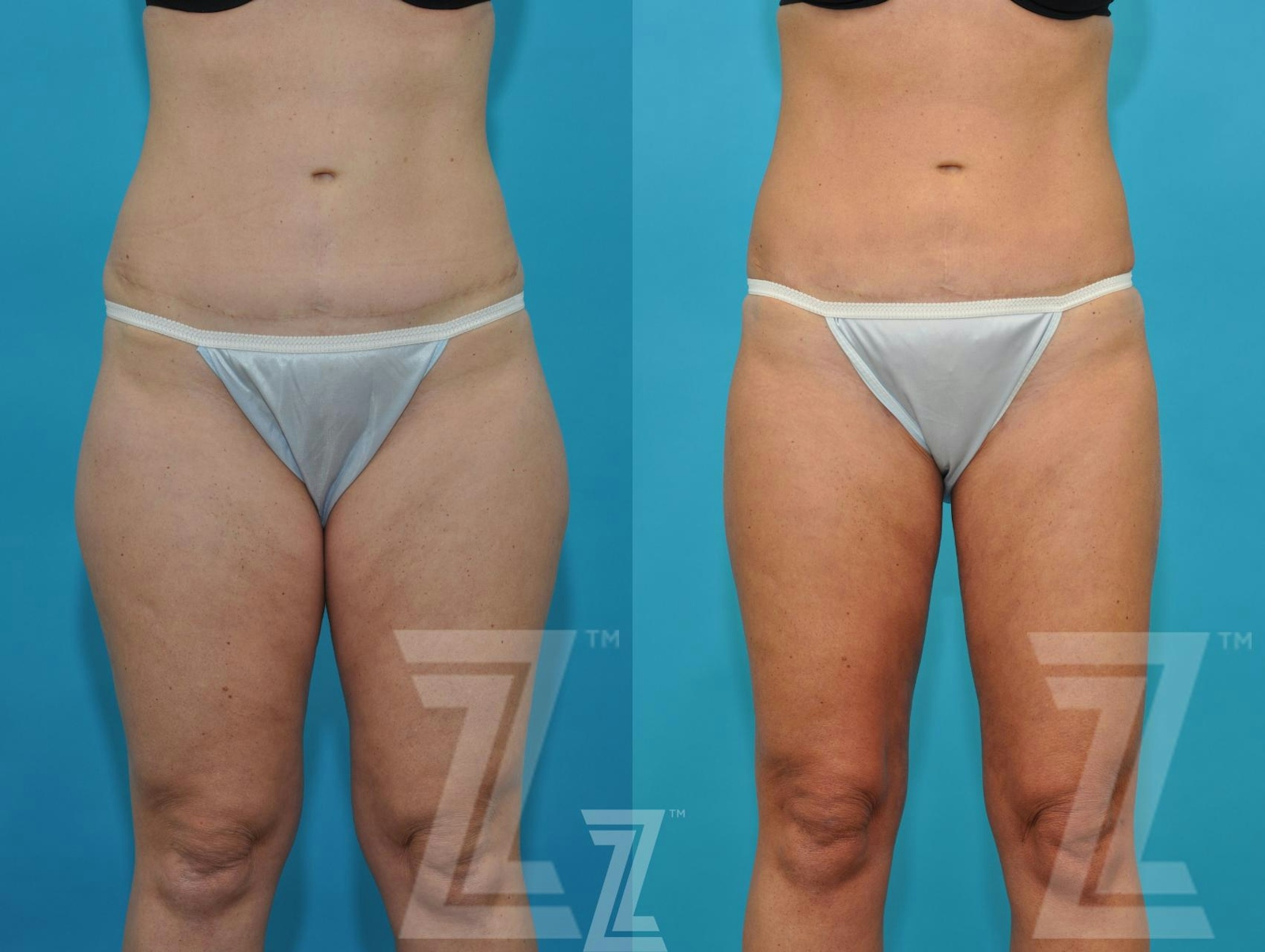 Austin Liposuction Before & After Gallery - Patient 132895980 - Image 1 - The Piazza Center
