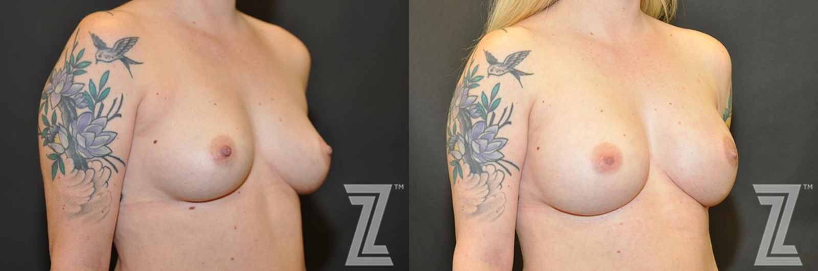 Austin Breast Reconstruction Before & After Gallery - Patient 132886770 - Image 4 - The Piazza Center