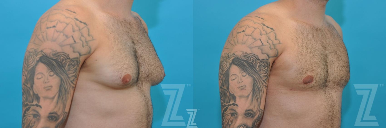 Austin Gynecomastia/Male Breast Reduction Before & After Gallery - Patient 118963 - Image 4 - The Piazza Center