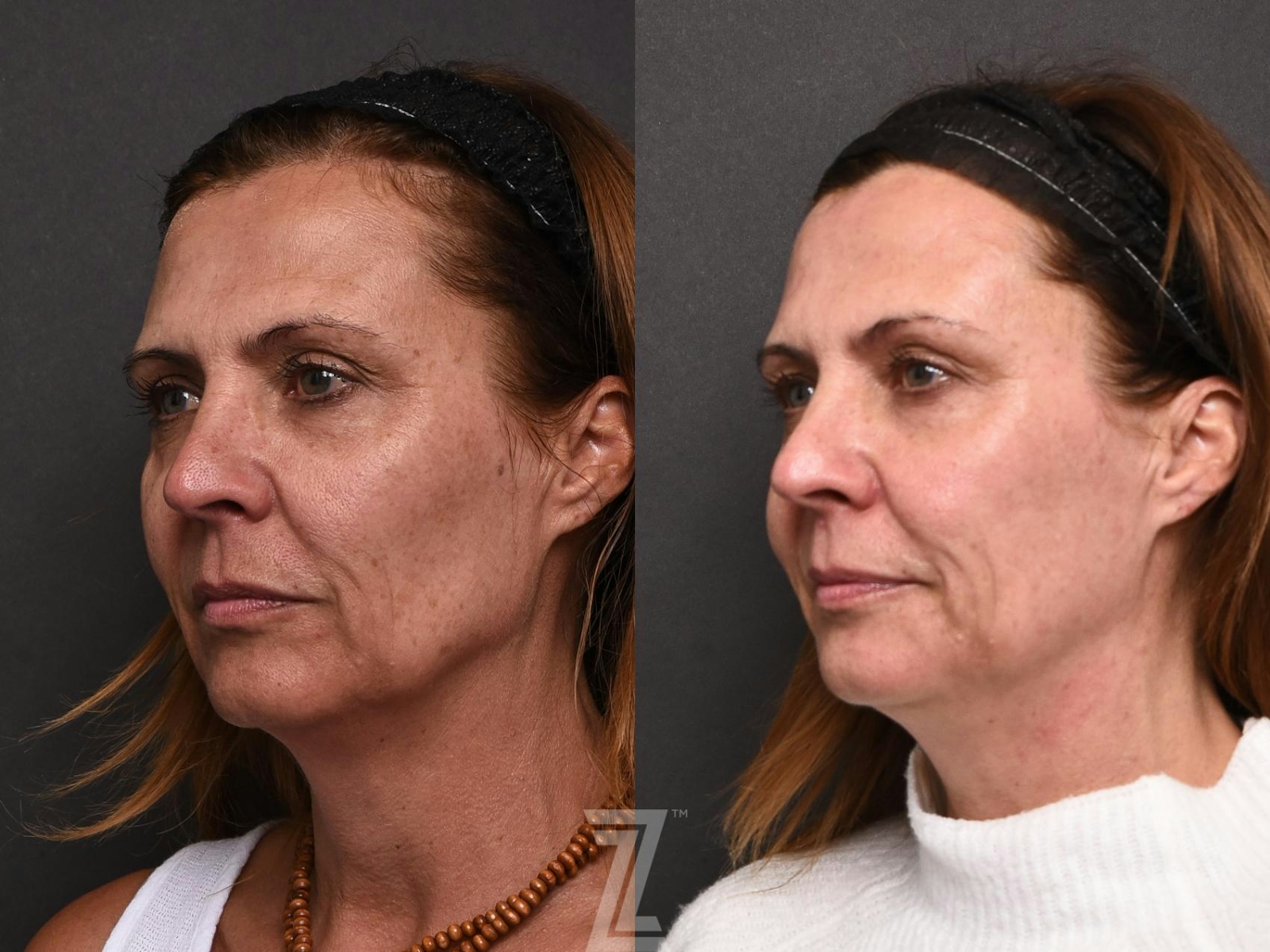 Austin HALO Before & After Gallery - Patient 132963260 - Image 3 - The Piazza Center
