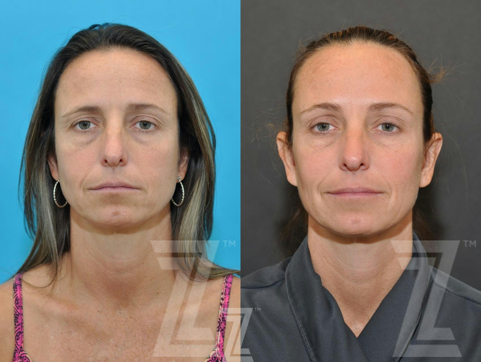 Austin Wrinkle Relaxers Before & After Gallery - Patient 132906321 - Image 1 - The Piazza Center