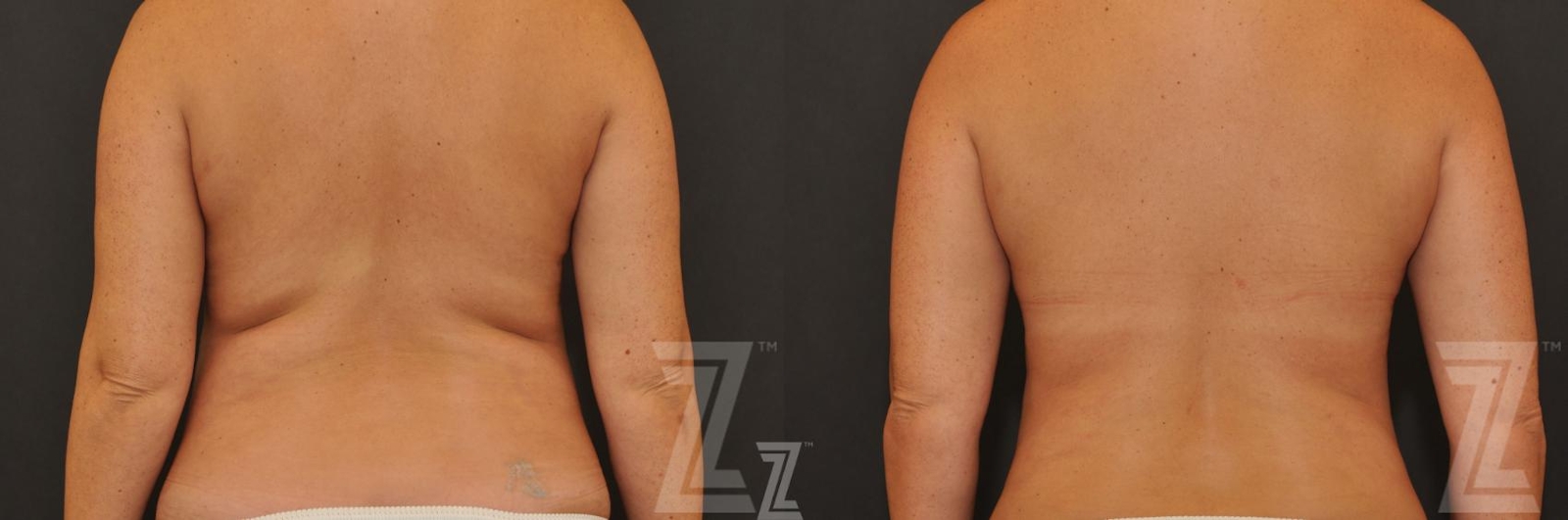 Austin CoolSculpting® Before & After Gallery - Patient 132905393 - Image 1 - The Piazza Center
