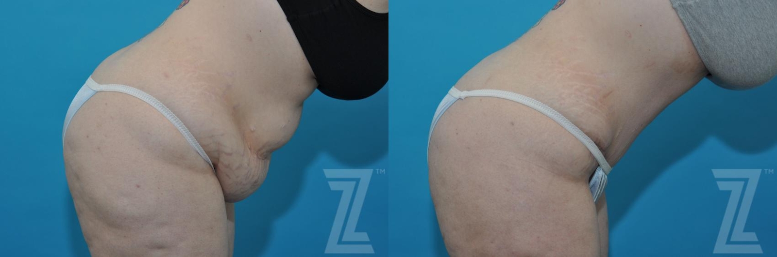 Austin Tummy Tuck Before & After Gallery - Patient 132886824 - Image 6 - The Piazza Center