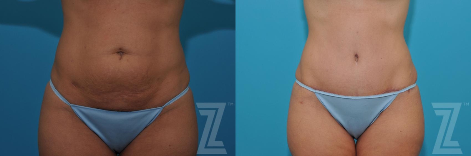 Austin Tummy Tuck Before & After Gallery - Patient 132886876 - Image 1 - The Piazza Center