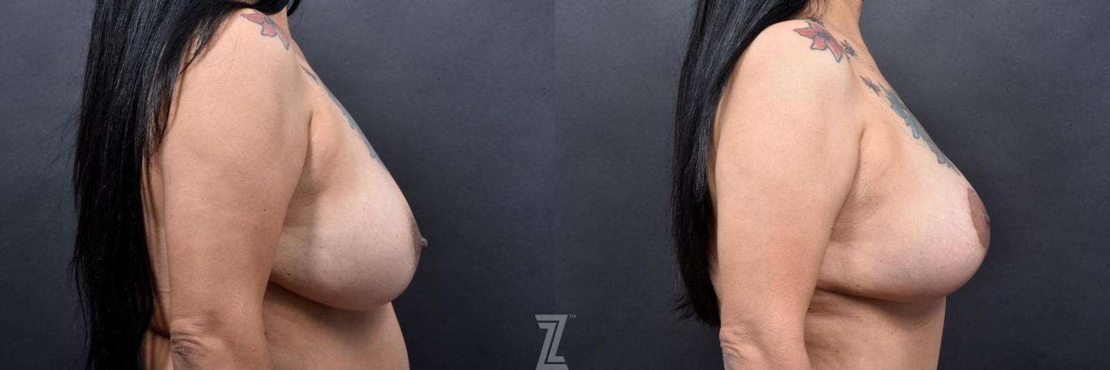 Austin Side View of Breasts 6 Month Post-OP Mommy Makeover in Austin, TX by Dr. Rocco Piazza - The Piazza Center