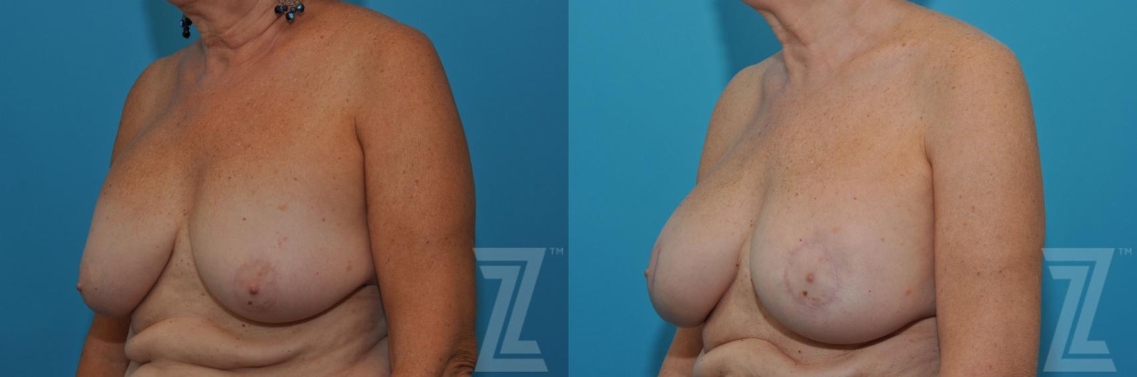 Austin Breast Augmentation Revision Before & After Gallery - Patient 132886586 - Image 2 - The Piazza Center