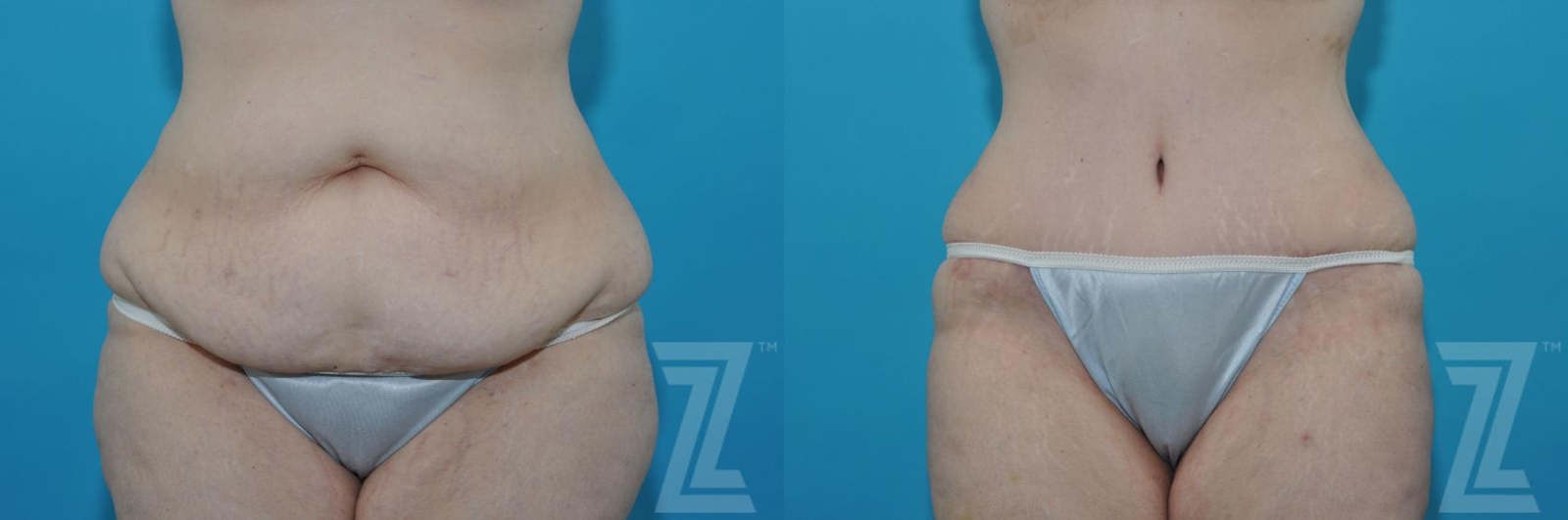 Austin Tummy Tuck Before & After Gallery - Patient 132886824 - Image 1 - The Piazza Center