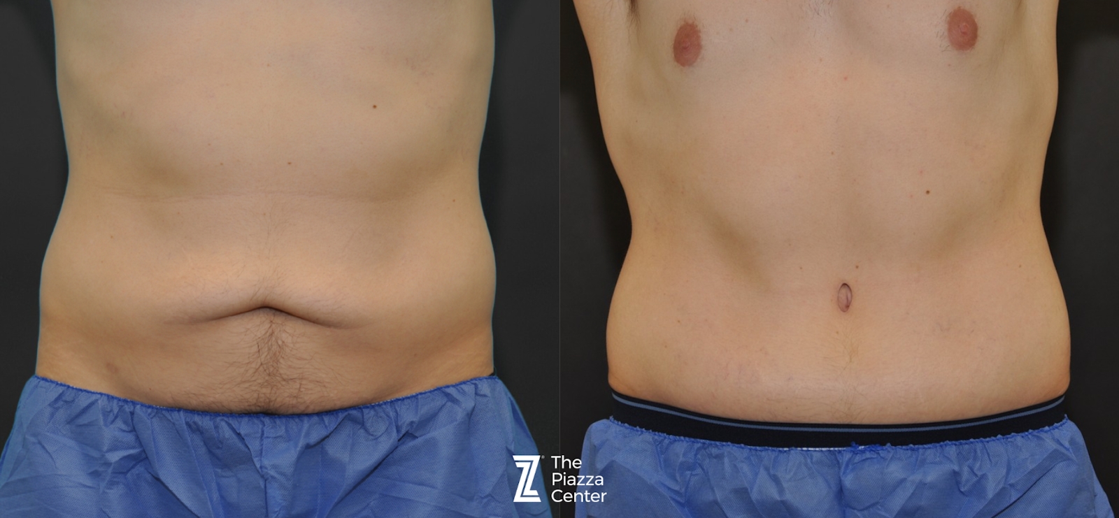 Austin Male Body Contouring Before & After Gallery - Patient 297384 - Image 1 - The Piazza Center