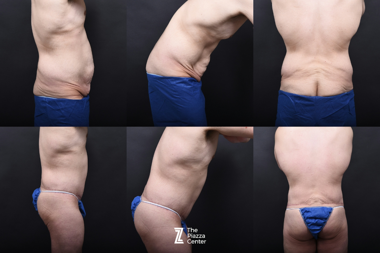 Austin Male Body Contouring Before & After Gallery - Patient 374227 - Image 8 - The Piazza Center