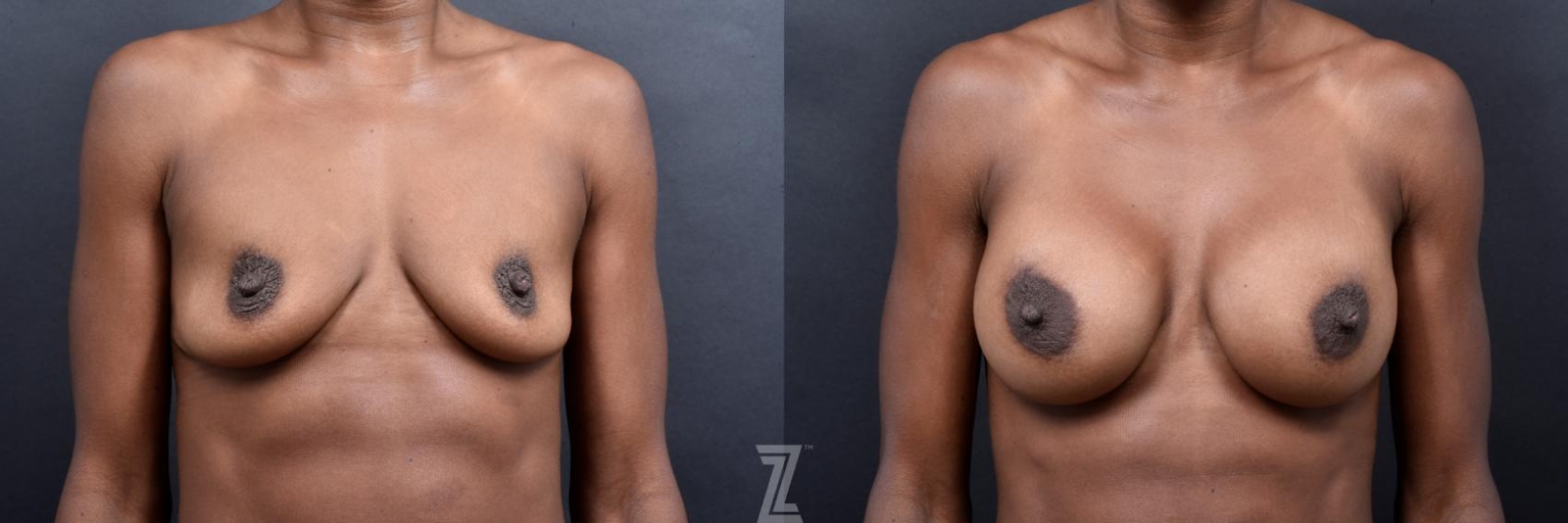 Austin Bilateral before and after view of 33 year old athletic mom of two children breast augmentation - The Piazza Center
