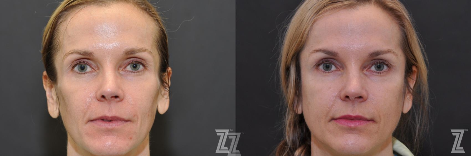 Austin Sculptra® Before & After Gallery - Patient 132963136 - Image 1 - The Piazza Center