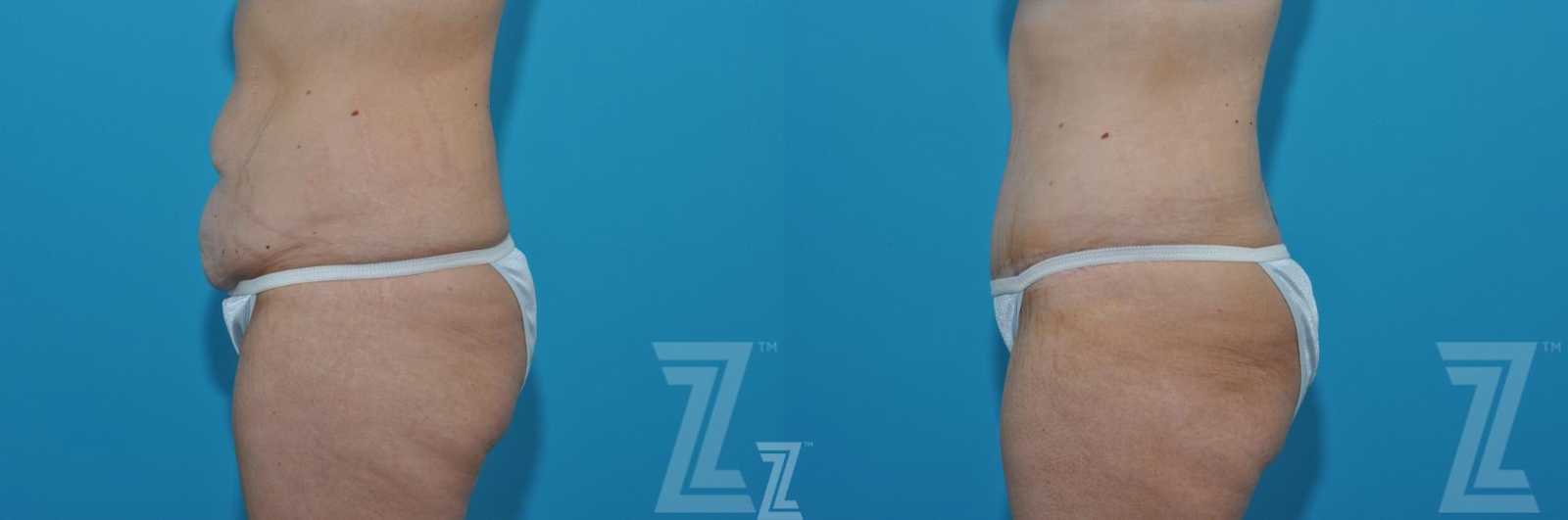 Austin Tummy Tuck Before & After Gallery - Patient 620256 - Image 2 - The Piazza Center