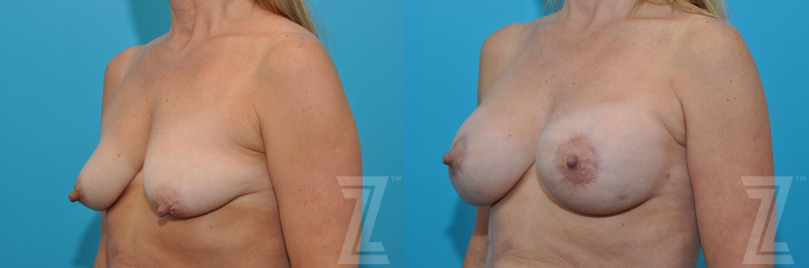 Austin Breast Augmentation With a Breast Lift Before & After Gallery - Patient 132791122 - Image 2 - The Piazza Center