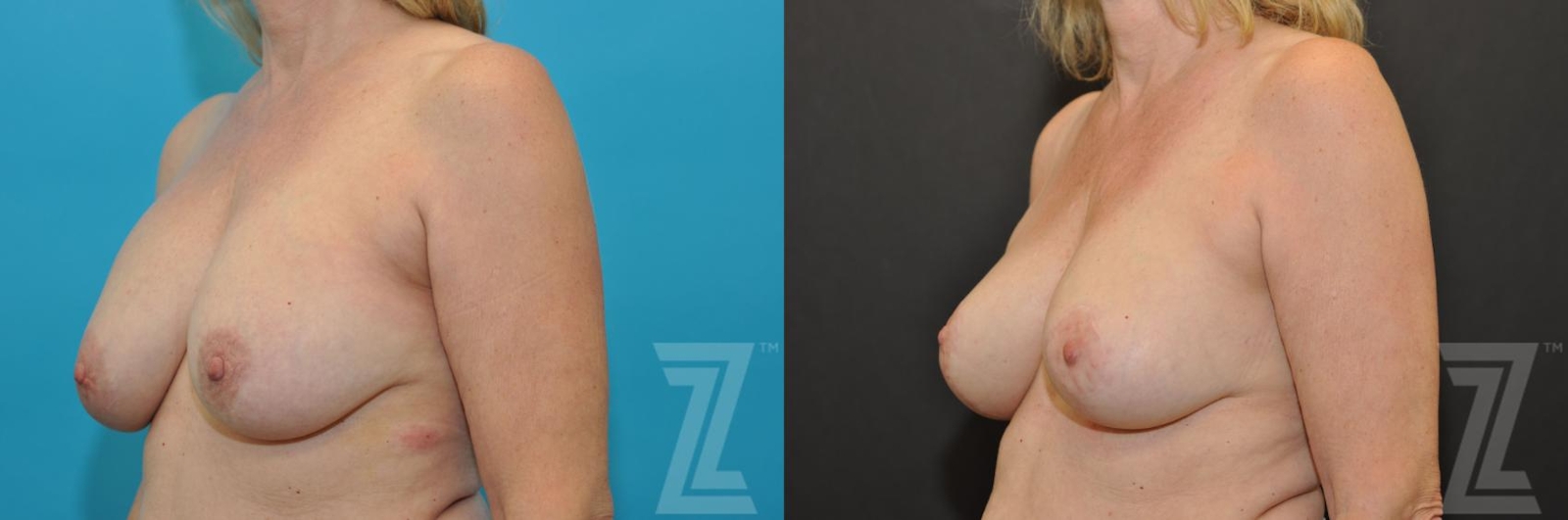 Austin Breast Augmentation Revision Before & After Gallery - Patient 132793346 - Image 2 - The Piazza Center