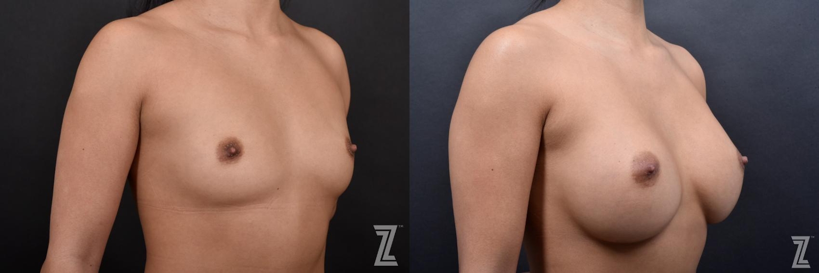 Austin Oblique View Before & After Breast Augmentation of 25-Year-Old Female Patient at The Piazza Center in Austin - Dr. Piazza - The Piazza Center