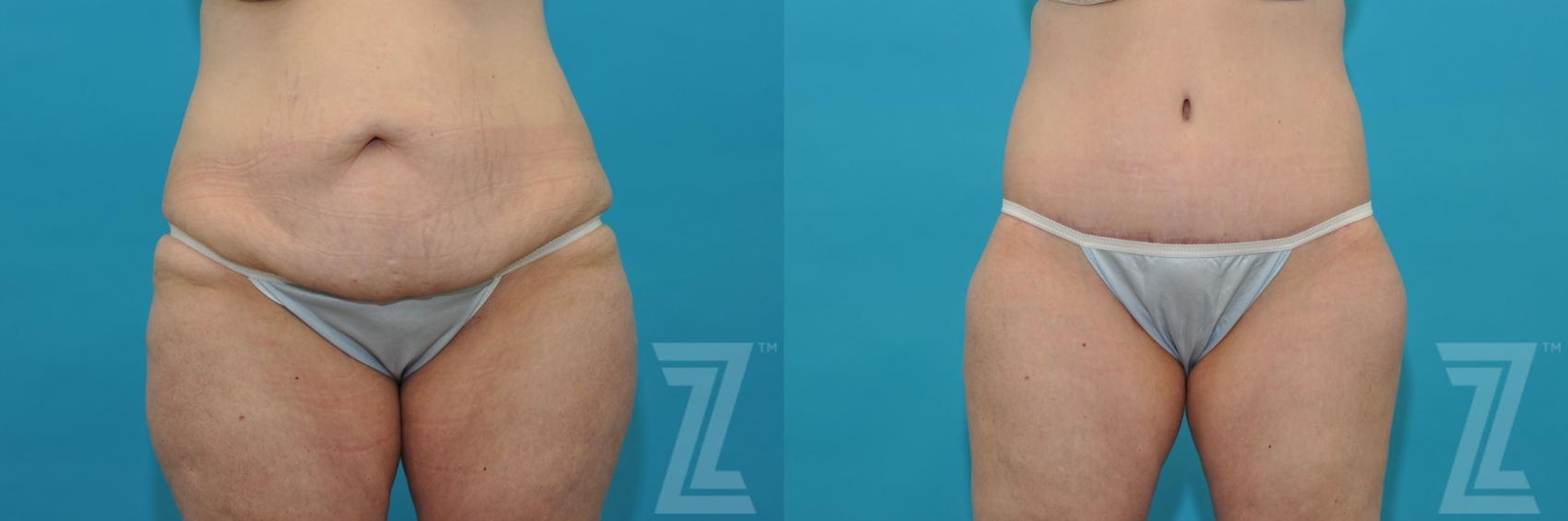 Austin Tummy Tuck Before & After Gallery - Patient 132886807 - Image 1 - The Piazza Center