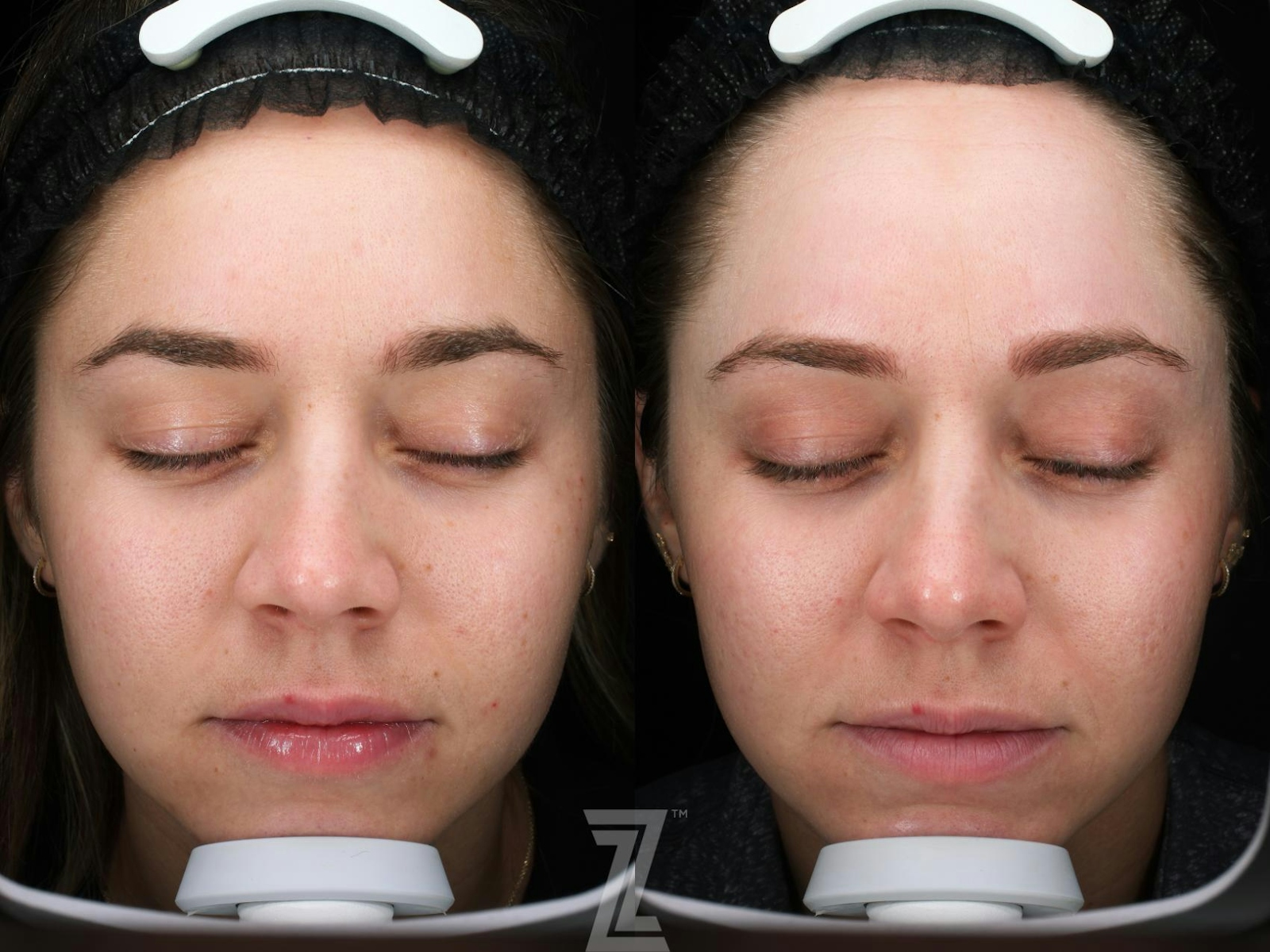 Austin SkinPen Microneedling Before & After Gallery - Patient 270635 - Image 2 - The Piazza Center