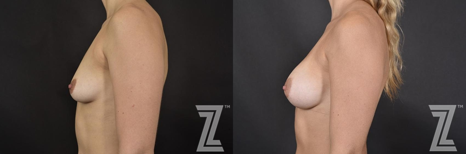Austin Lateral view before & after images of 32 year old woman with breat augmentation at the Piazza Center - The Piazza Center