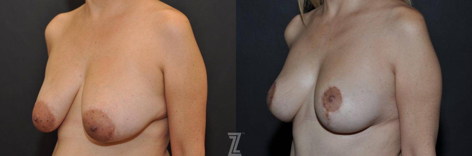Austin Breast Reduction Before & After Gallery - Patient 132886614 - Image 2 - The Piazza Center