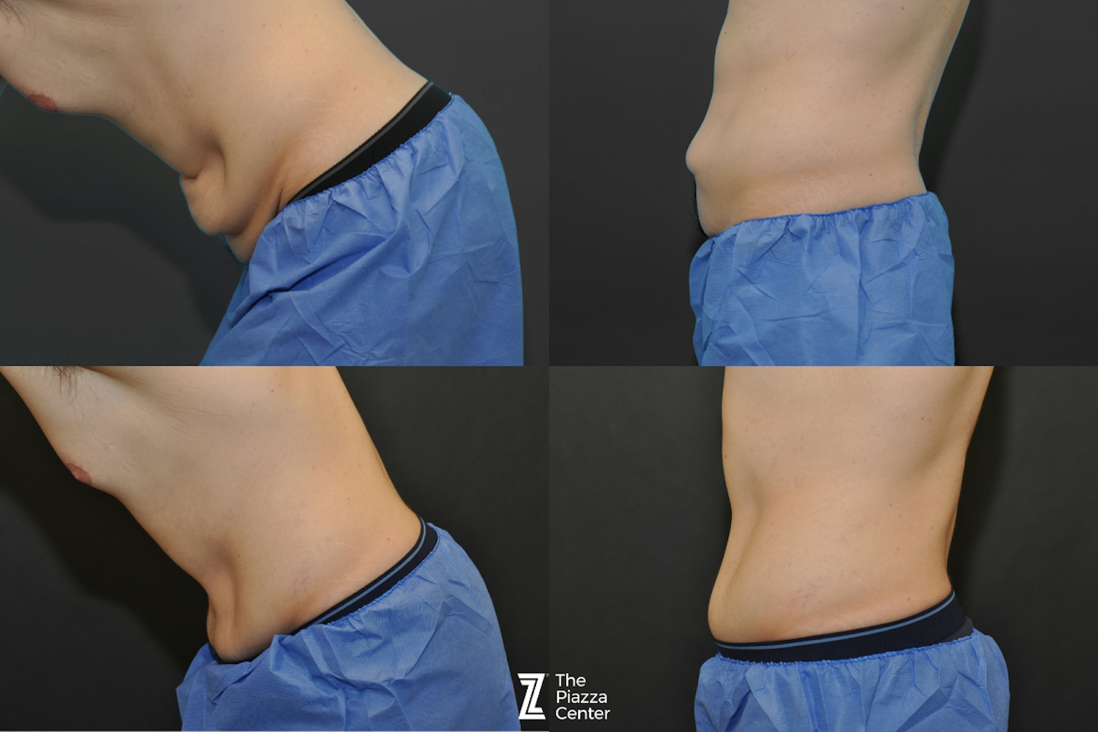 Austin Tummy Tuck Before & After Gallery - Patient 166370 - Image 2 - The Piazza Center