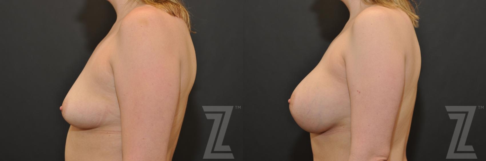 Austin Lateral view before and after images of 32 year old woman with Silicone Implants with Cohesive Silicone Gel - The Piazza Center
