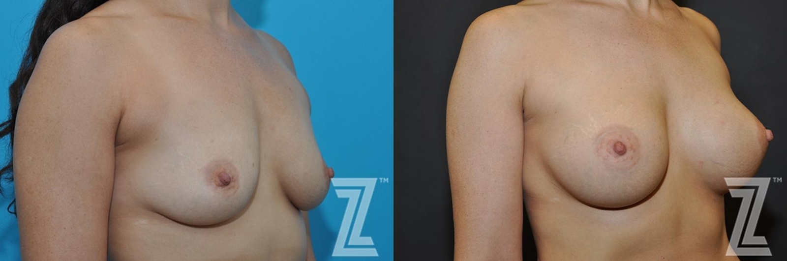 Austin Oblique View before & after images of 33 year old woman with breast augmentation - The Piazza Center - The Piazza Center
