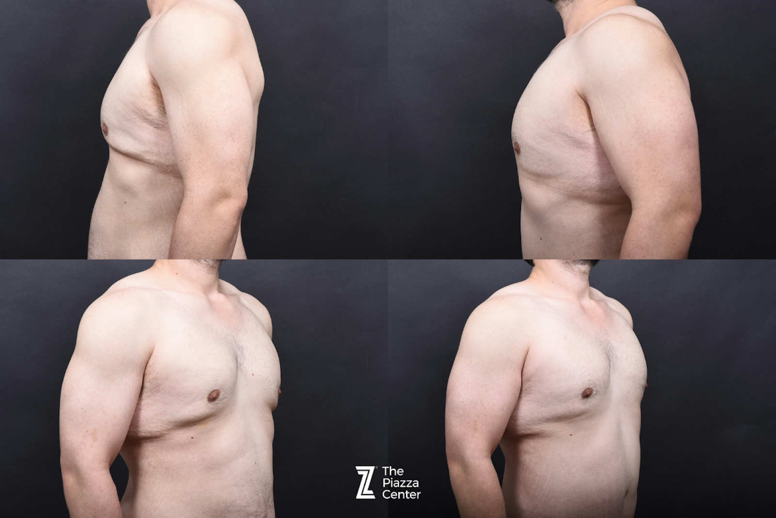 Austin Male Body Contouring Before & After Gallery - Patient 374227 - Image 10 - The Piazza Center