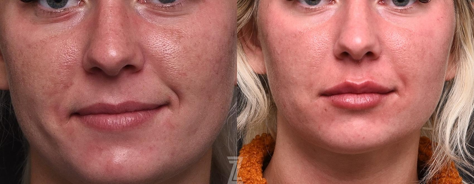 Austin Injectable Fillers Before & After Gallery - Patient 132963106 - Image 1 - The Piazza Center