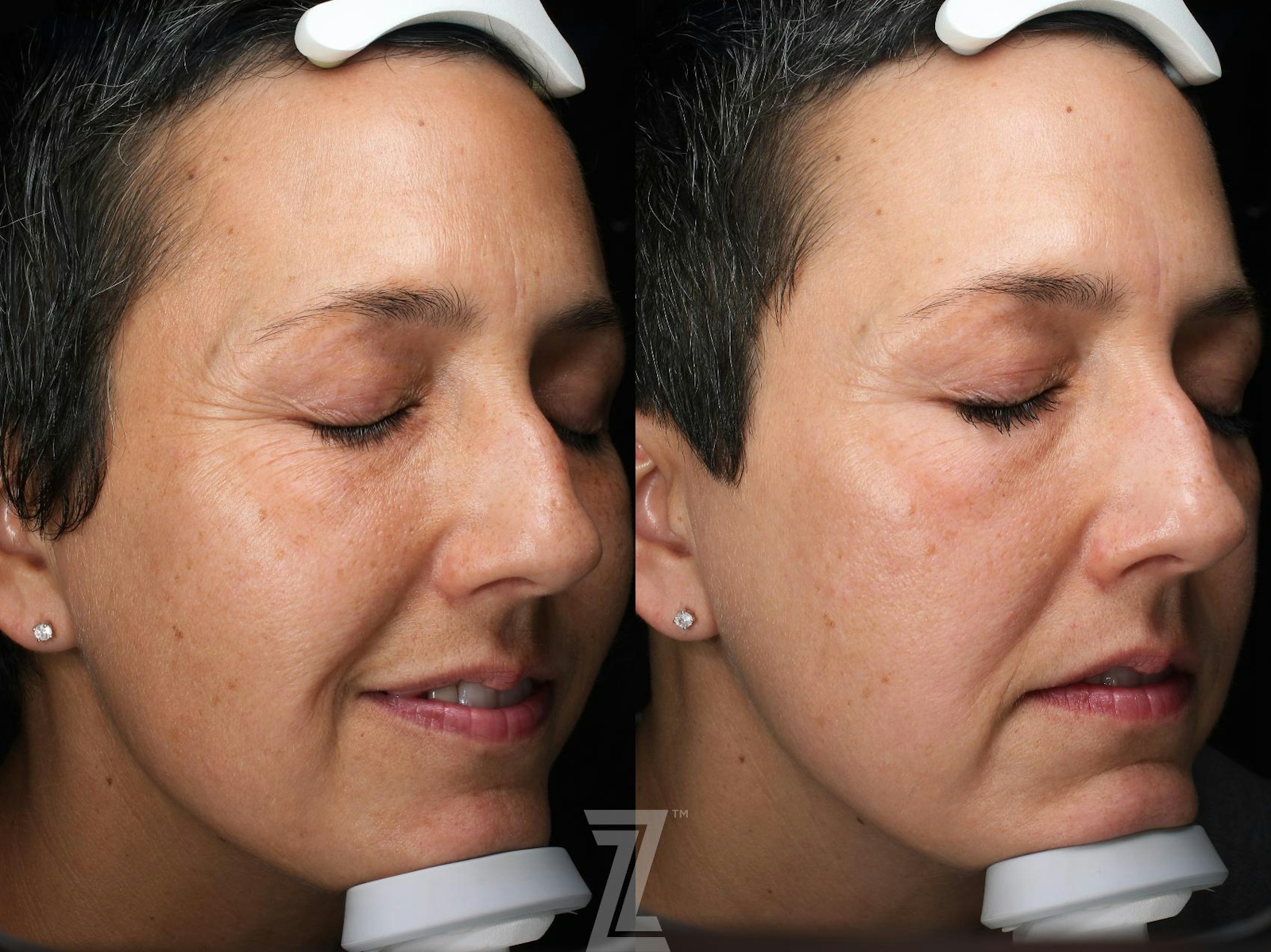 Austin HALO Before & After Gallery - Patient 386324 - Image 2 - The Piazza Center