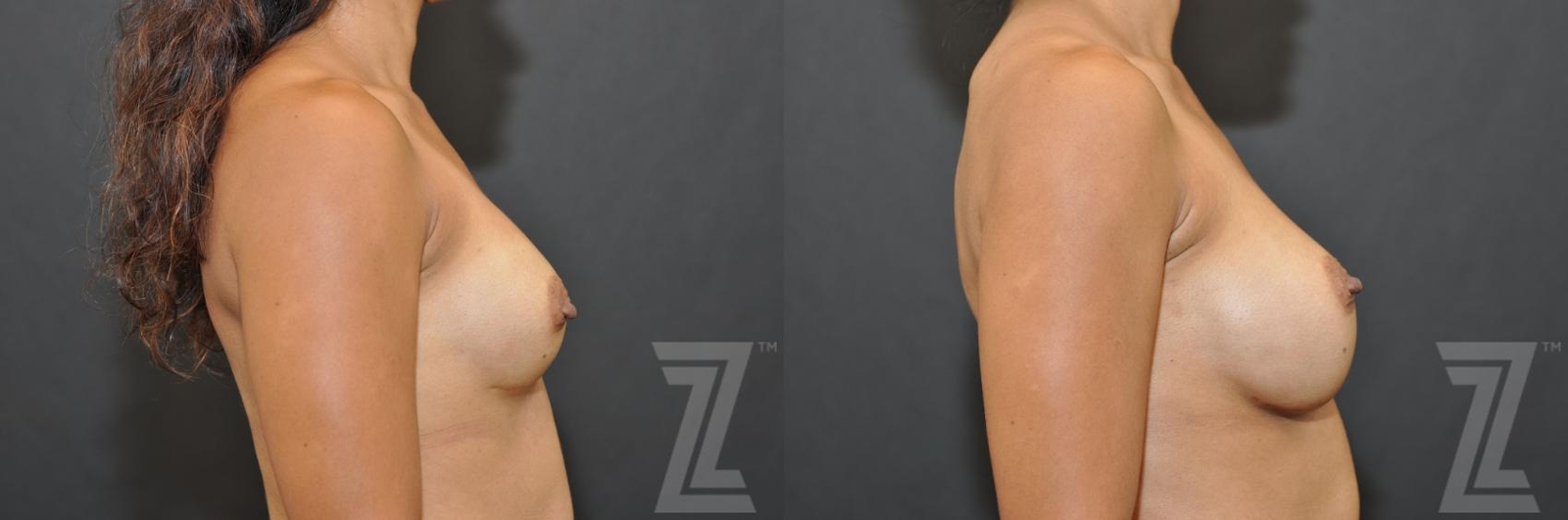 Austin Breast Augmentation Revision Before & After Gallery - Patient 132886551 - Image 5 - The Piazza Center