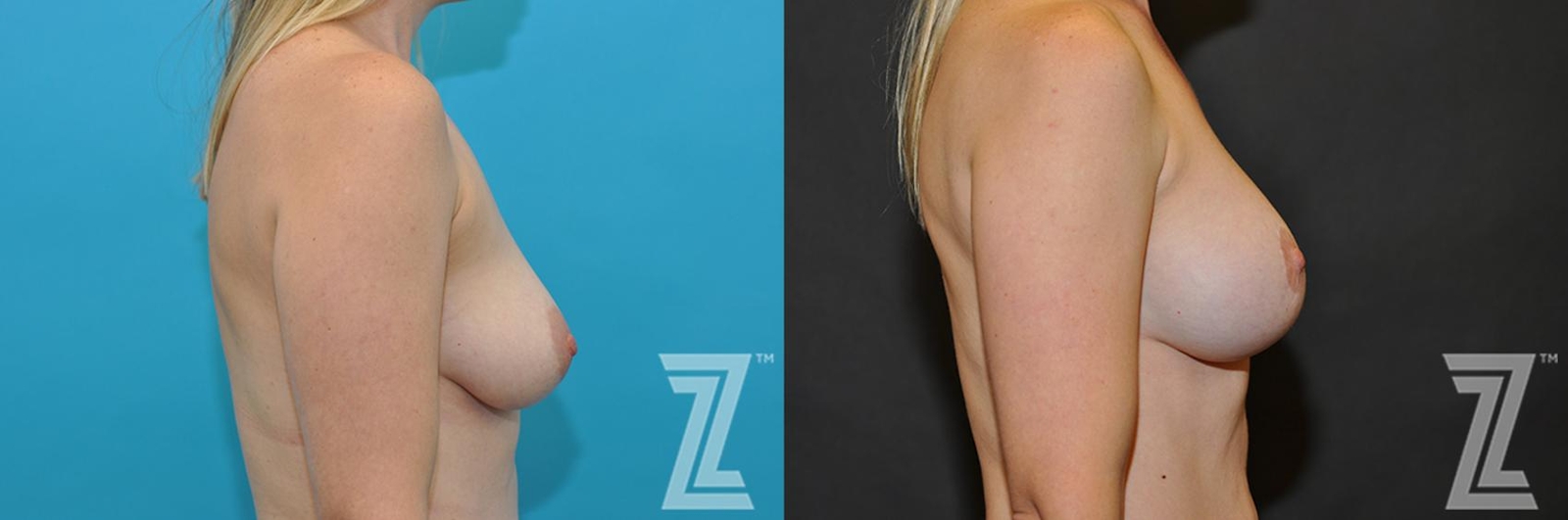 Austin Breast Augmentation With a Breast Lift Before & After Gallery - Patient 132791112 - Image 2 - The Piazza Center