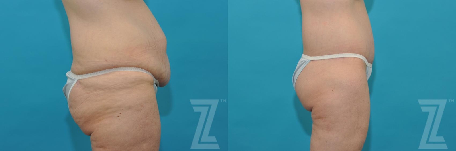 Austin Tummy Tuck Before & After Gallery - Patient 132886807 - Image 4 - The Piazza Center